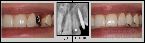 Одноэтапная имплантация зуба в Израиле - Фото клинического случая №9